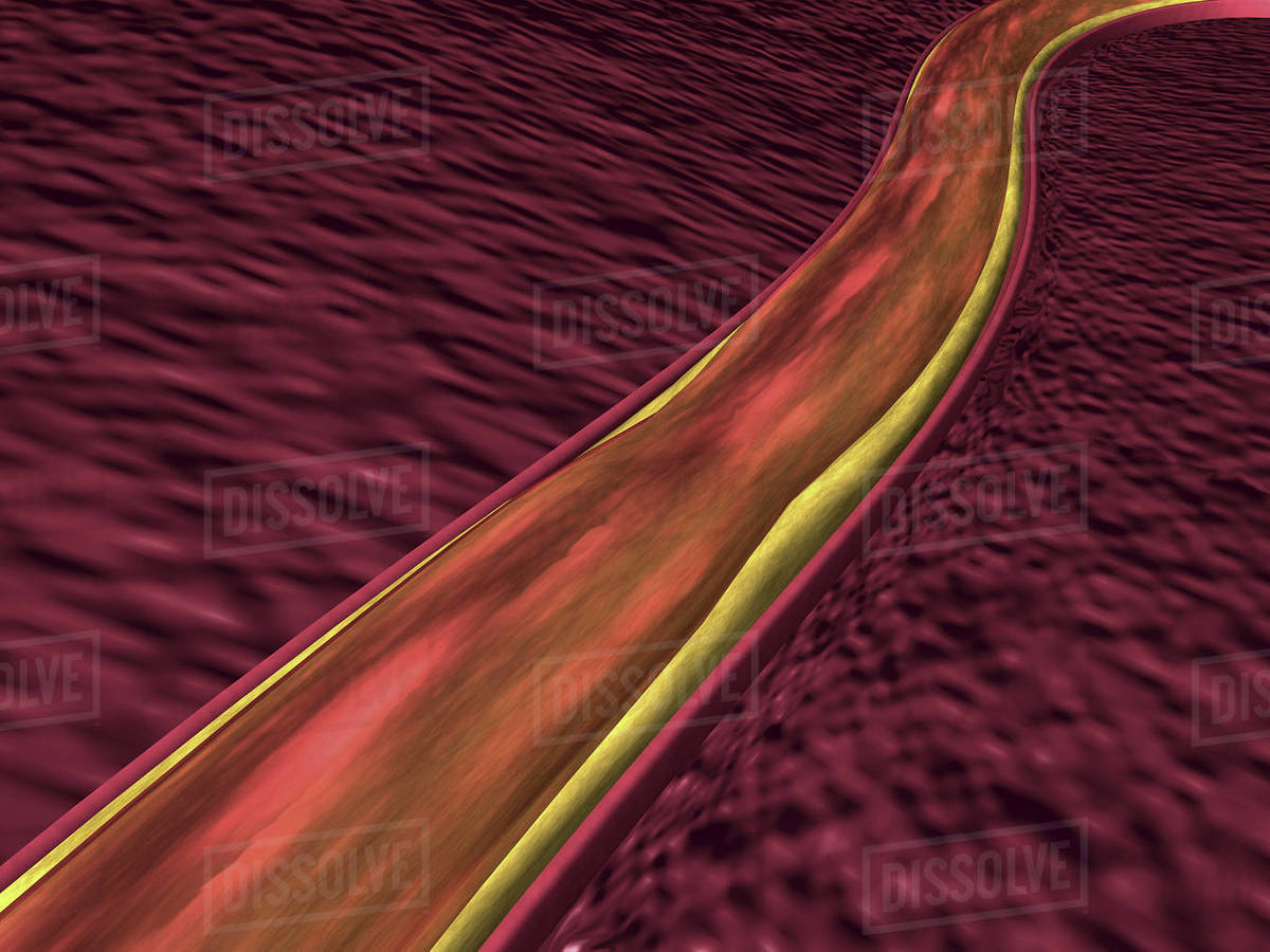 Closeup of the human artery showing fat deposited on the inner walls