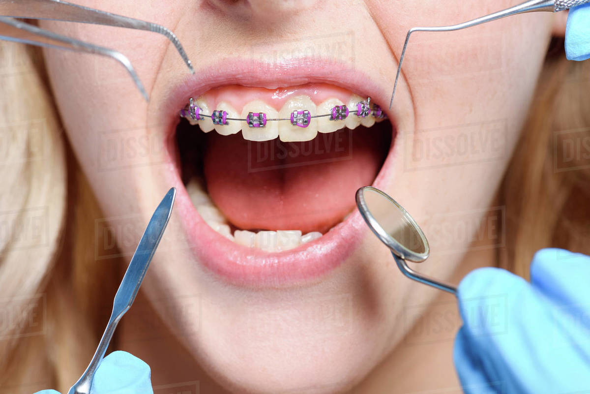 Closeup shot of dentist tools in front of open mouth with braces