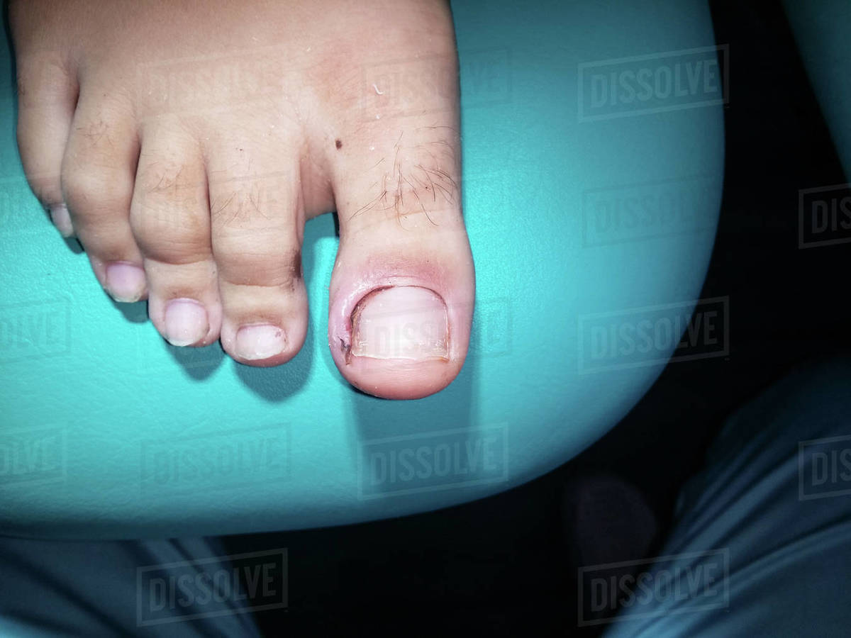 Inflamed big toe with ingrown toenail Stock Photo Dissolve