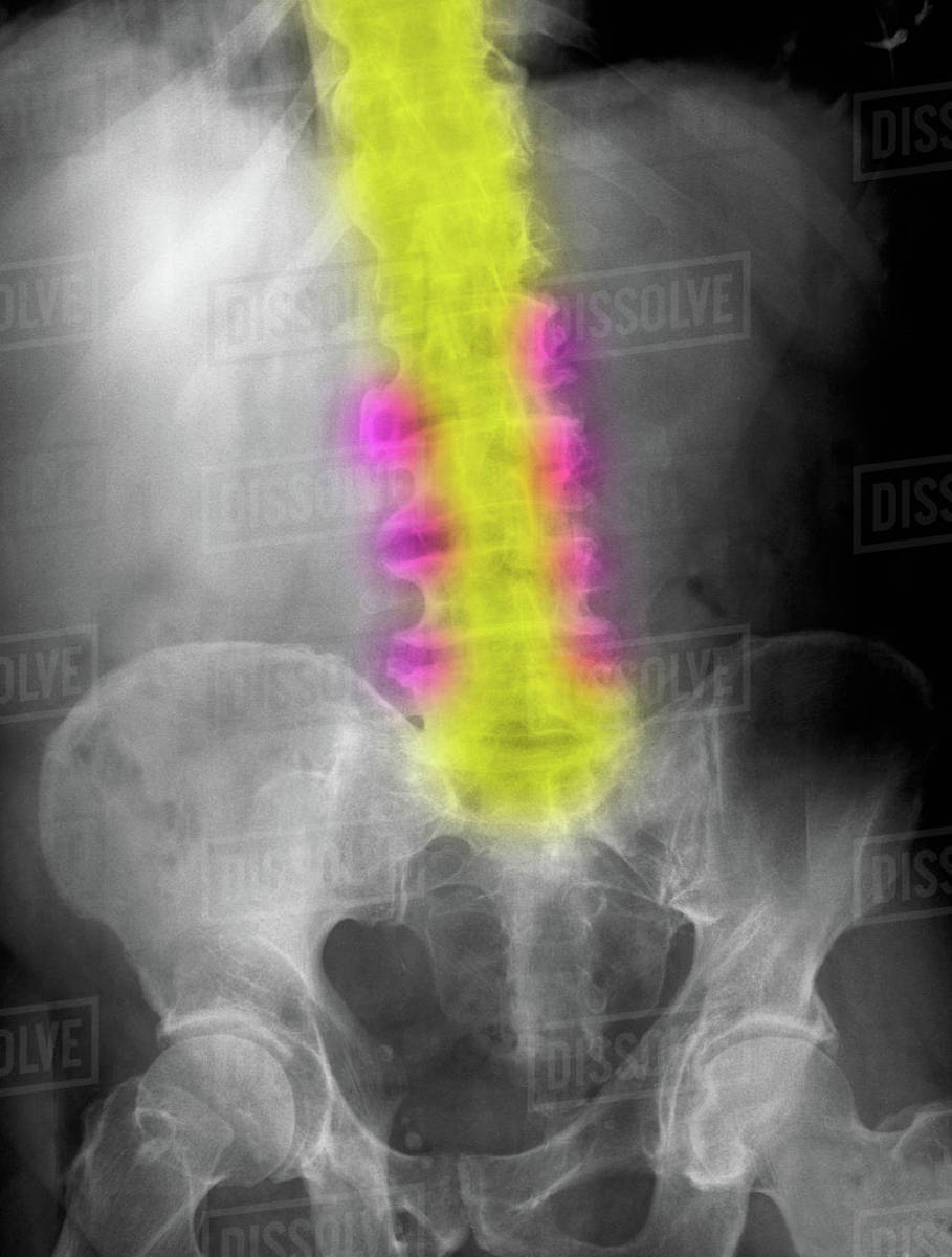 Xray, osteoarthritis of the spine, bone spurs Stock Photo Dissolve