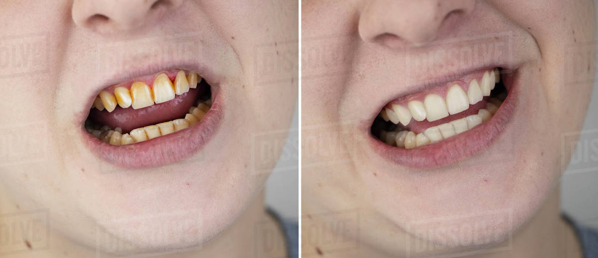 Teeth of a man before and after bleaching. The dentist removed yellow