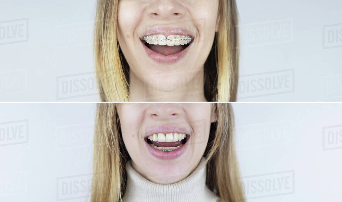 Before and after remove braces. On left is a girl in a metal bracket