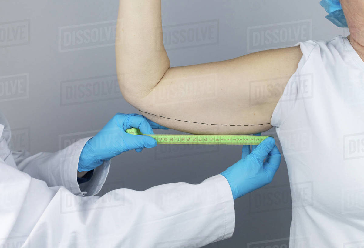 Brachioplasty. Plastic arms, dangling skin at the elbow. An older woman shows the surgeon