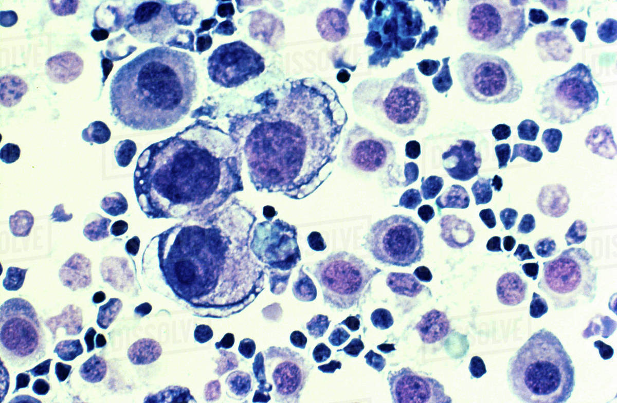 Metastatic breast cancer in pleural fluid Stock Photo Dissolve