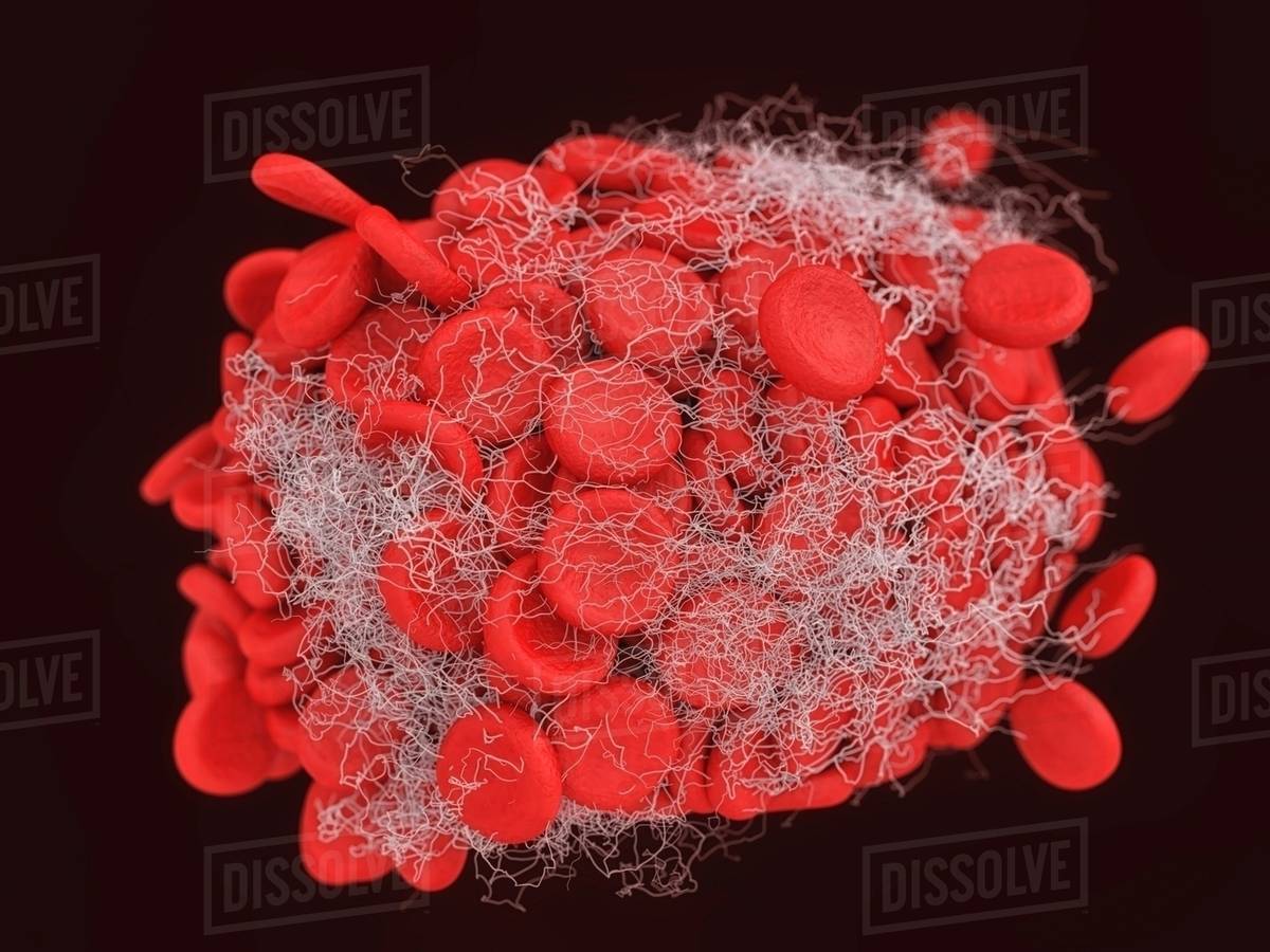 Illustration of a blood clot showing a clump of red blood cells ...